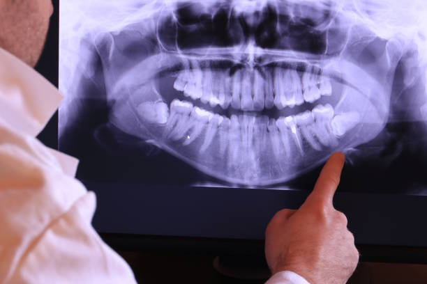 Best Emergency Wisdom Teeth Removal in Nazareth College, NY